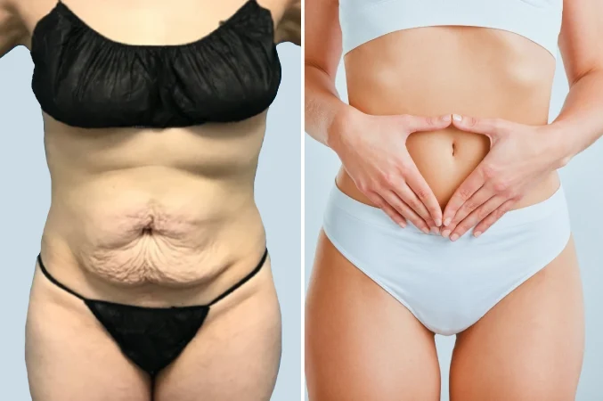 Tummy Restoration & Sculpting